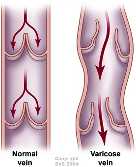 Vascular surgery