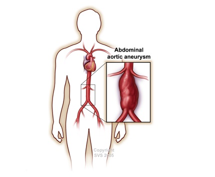 Vascular surgery